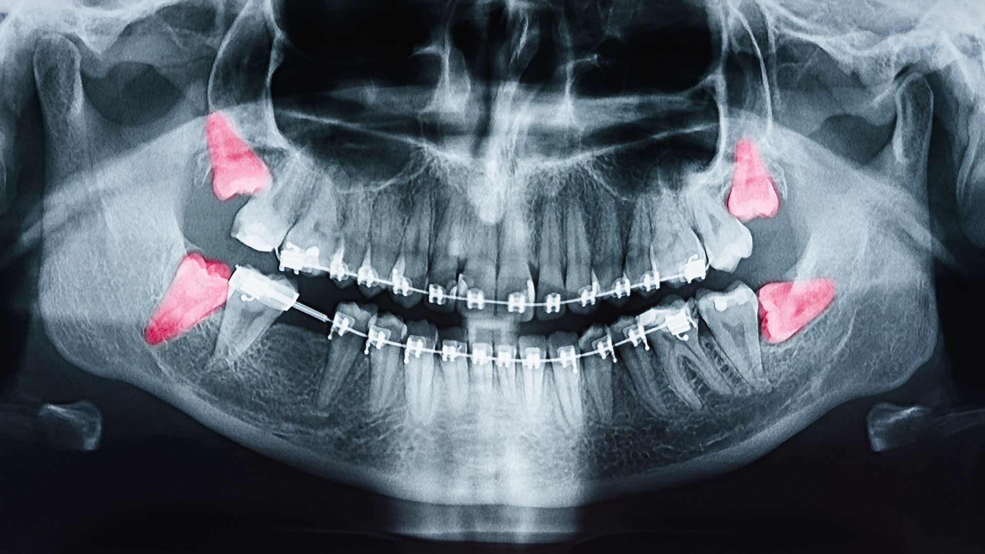 This is an X-ray image showing a human skull with prominent teeth, two red markers on the upper teeth, and a metal wire with screws attached to the lower jaw.