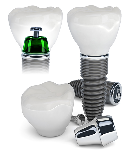 Dental Implants in Radburn