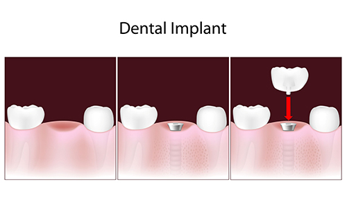 Fair Lawn Dental Implants