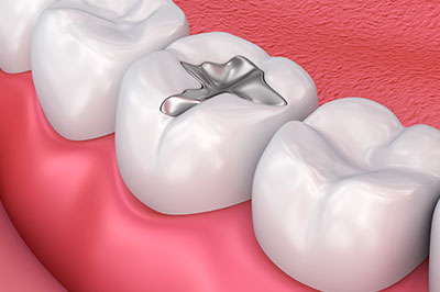 The image shows a close-up view of a human dental arch with teeth, including one with an implant, against a pink background that resembles gum tissue.