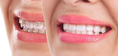 The image displays a woman s smiling face with a focus on her teeth, which are enhanced by braces, set against a background that appears to be a close-up of another part of her face.