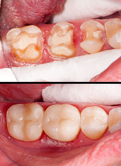 The image displays a set of teeth with visible signs of decay and damage, emphasizing dental health concerns.