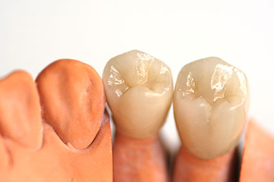 The image shows two sets of dentures placed side by side on a white background, with one set having a natural tooth appearance and the other appearing more artificial or plastic-like.