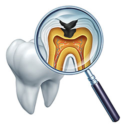 The image depicts a magnified view of a tooth with an internal structure visible through a transparent magnifying glass, revealing detailed anatomical features including roots, pulp chamber, and nerve endings, with a focus on a cavity.