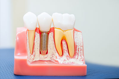 The image shows a model of a human mouth with artificial teeth and gums, featuring a visible tooth extraction tool inserted into one of the teeth.