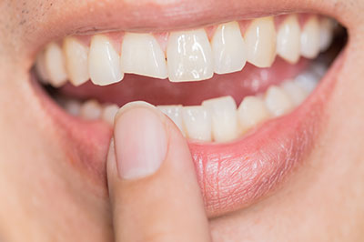 The image shows a person holding their finger near their mouth with a smile, revealing a dental implant on the upper left side of their teeth.