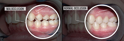 The image shows two panels side by side  on the left, a close-up of an open mouth with visible teeth and gums  on the right, a magnified view of the same mouth, focusing on the lower front teeth and gumline, with text indicating  malocclusion  and highlighting irregularities.