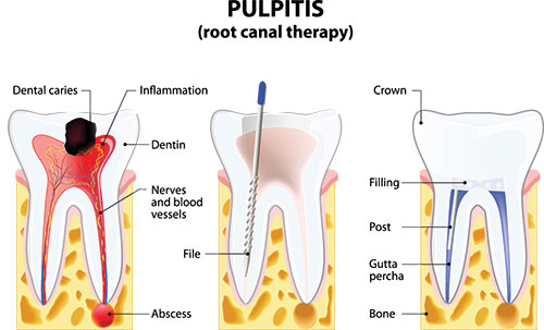 The image displays a medical illustration showing the anatomy of a tooth with its roots, crown, and pulp chamber labeled, highlighting the structure of a human tooth and surrounding tissues within a cross-sectional view.