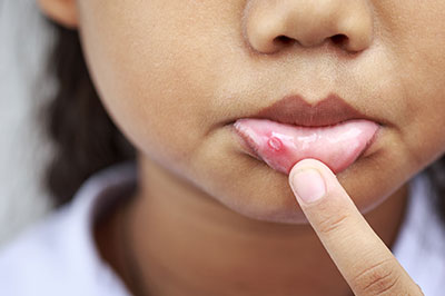 A young child with a pimple on their face, pointing at it with their finger.