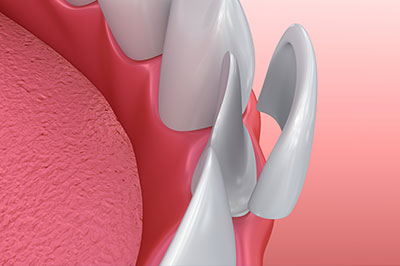 The image displays a close-up view of a dental implant with a pink gum tissue background, showcasing the implant s design and structure.