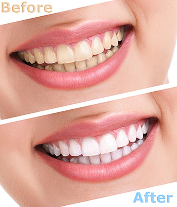 The image shows a side-by-side comparison of a person s teeth before and after a dental treatment, highlighting the transformation with a smile and an overlay text that reads  BEFORE  and  AFTER.