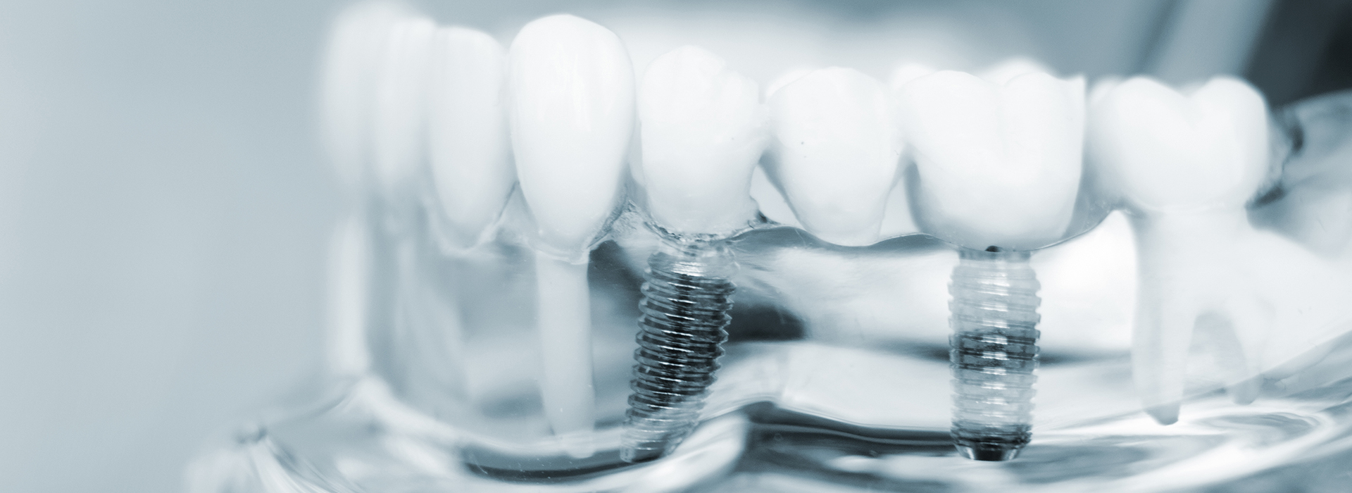 The image shows a close-up view of a set of dentures with visible screws and teeth, presented against a blurred background.