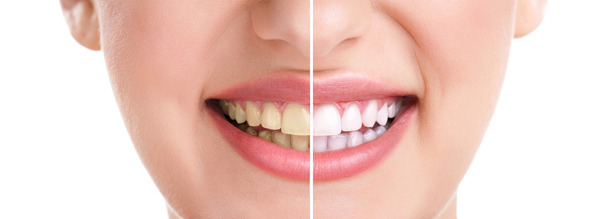 The image shows a close-up of a person s face with a focus on a smile, highlighting teeth whitening before and after treatment.