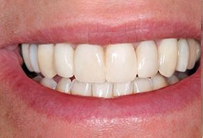 The image shows a close-up of a person s smiling mouth with straight white teeth, and the individual appears to be middle-aged or older.
