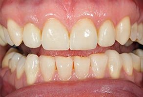 The image shows a close-up view of an individual s teeth, with the top front teeth prominently featured, exhibiting signs of discoloration or staining.