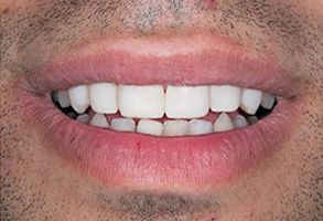 The image shows a close-up of a person s mouth with teeth showing, smiling broadly, against a plain background.