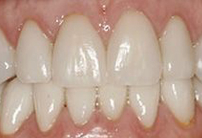 The image shows a close-up view of a person s teeth, with a focus on the lower front teeth, which appear to be discolored or stained, likely due to tobacco use.