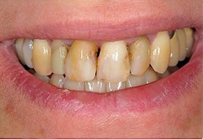 The image shows a close-up of a person s mouth with yellowed teeth and a partial denture.