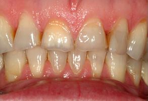 The image shows a close-up view of a person s teeth with a focus on their gums, which appear inflamed and yellowed.