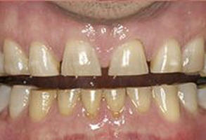 The image shows a close-up view of a person s teeth with yellowing and staining, which may indicate poor oral hygiene or the effects of tobacco use.